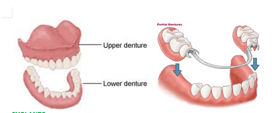 Removable Full or Partial Dentures